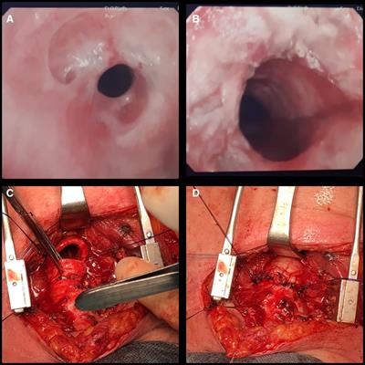 Management of COVID-19-related post-intubation tracheal stenosis